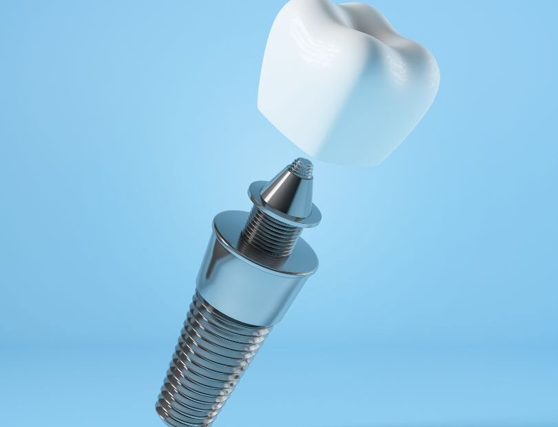 Why Aren'T Implants Covered by Dental Insurance